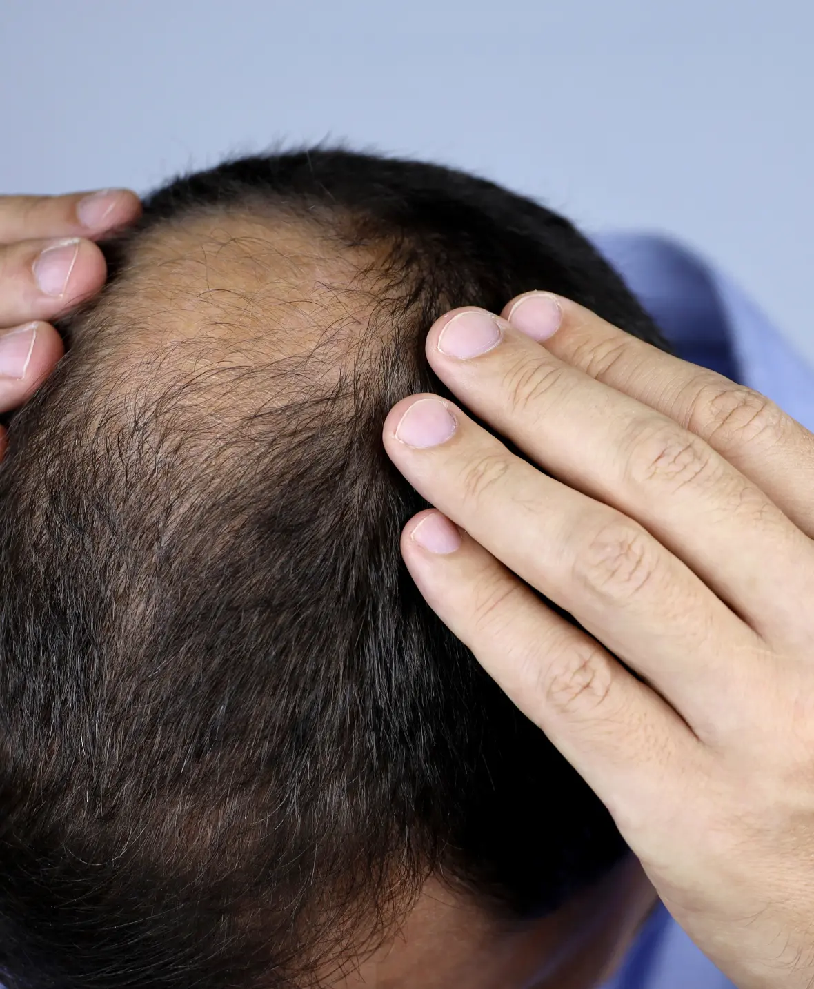 Hair Restoration Transplantation img3