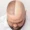 Hair Restoration Transplantation img4