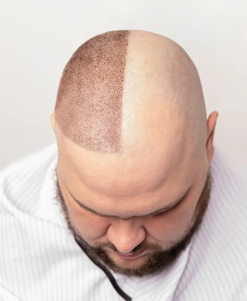Hair Restoration Transplantation img4