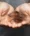 Hair loss causes img