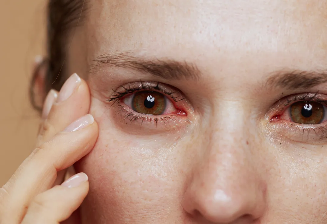 Urgent Care for Red Eye