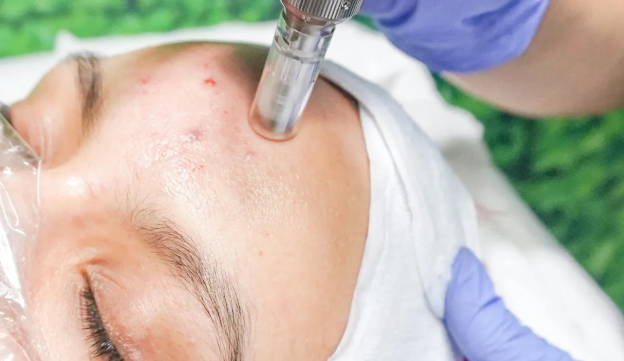 Derm Abrasion testimonial img2