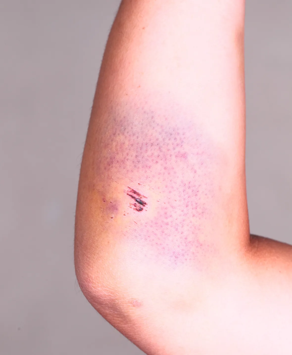 Evacuation of Haematoma img1