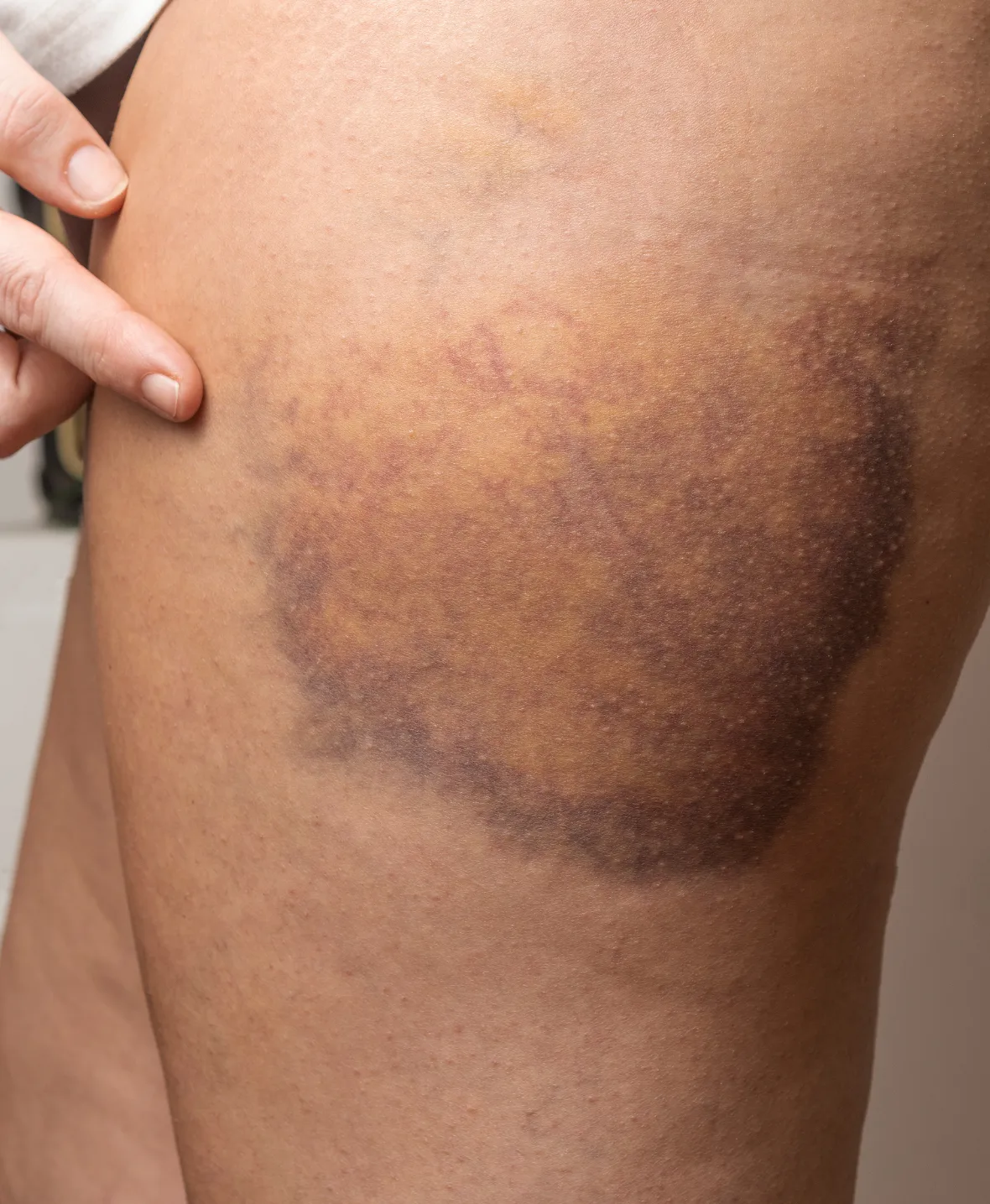 Evacuation of Haematoma img2