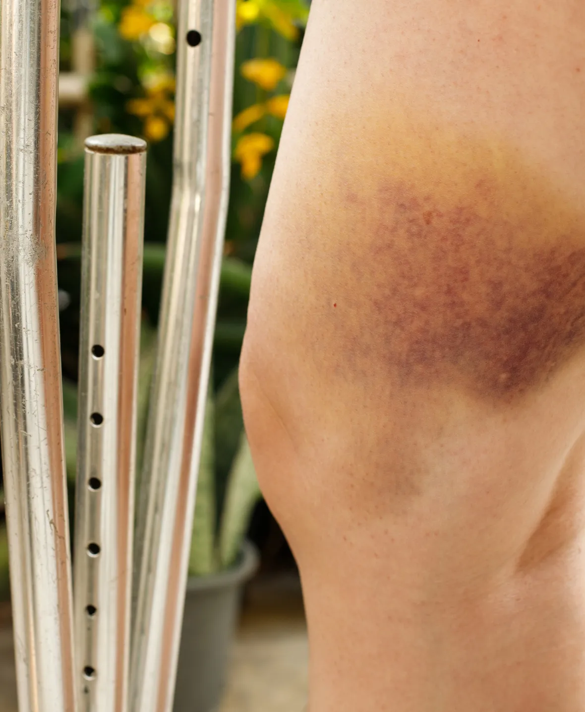 Evacuation of Haematoma img3