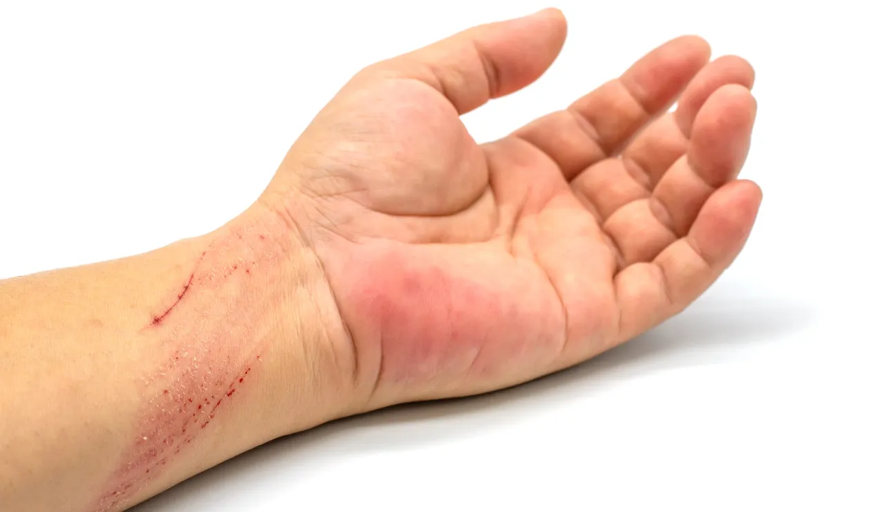 Evacuation of haematoma testimonial img1