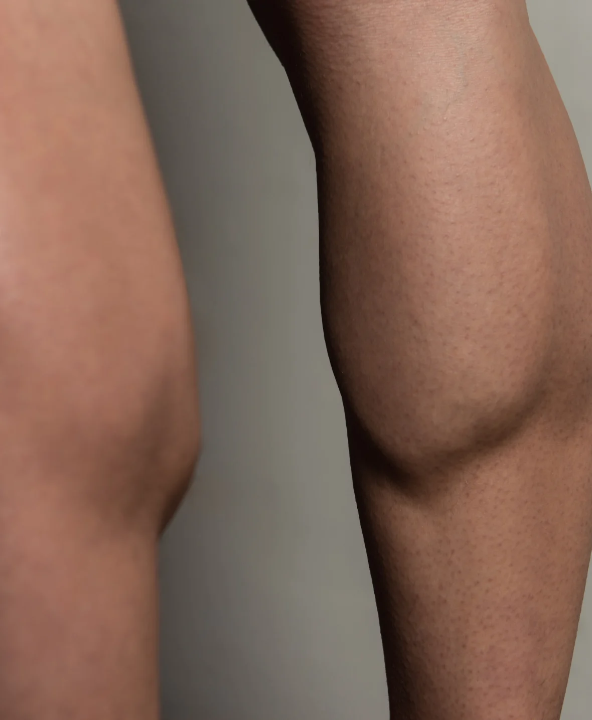 Calf Augmentation img4