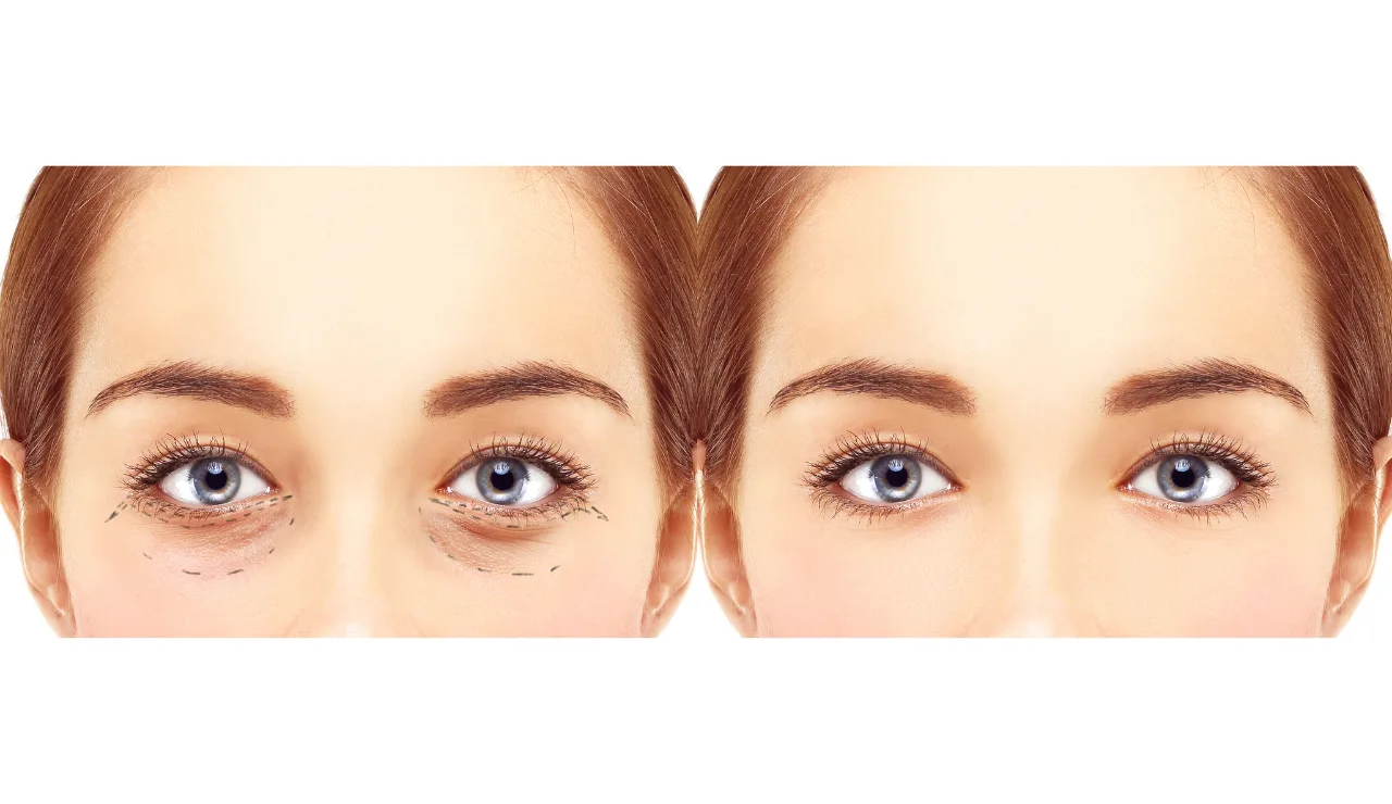 Canthopexy testimonial img2 2