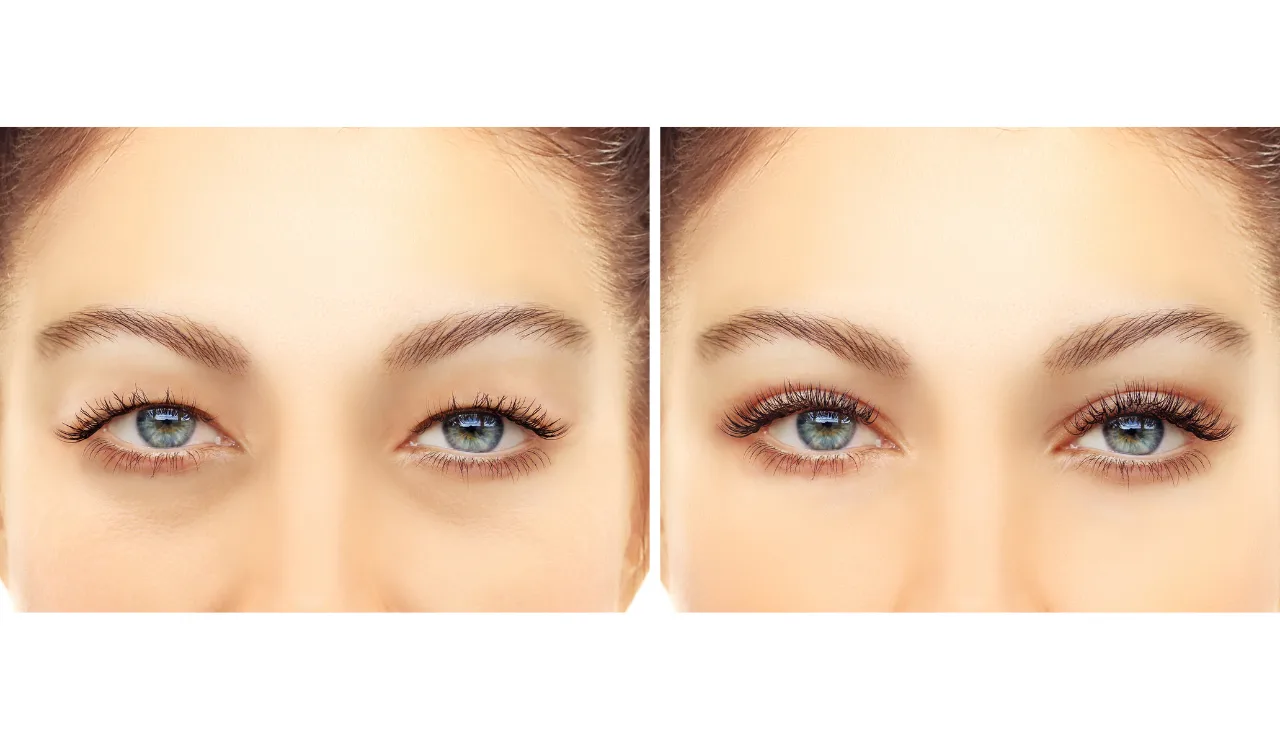 Canthopexy testimonial img2 3