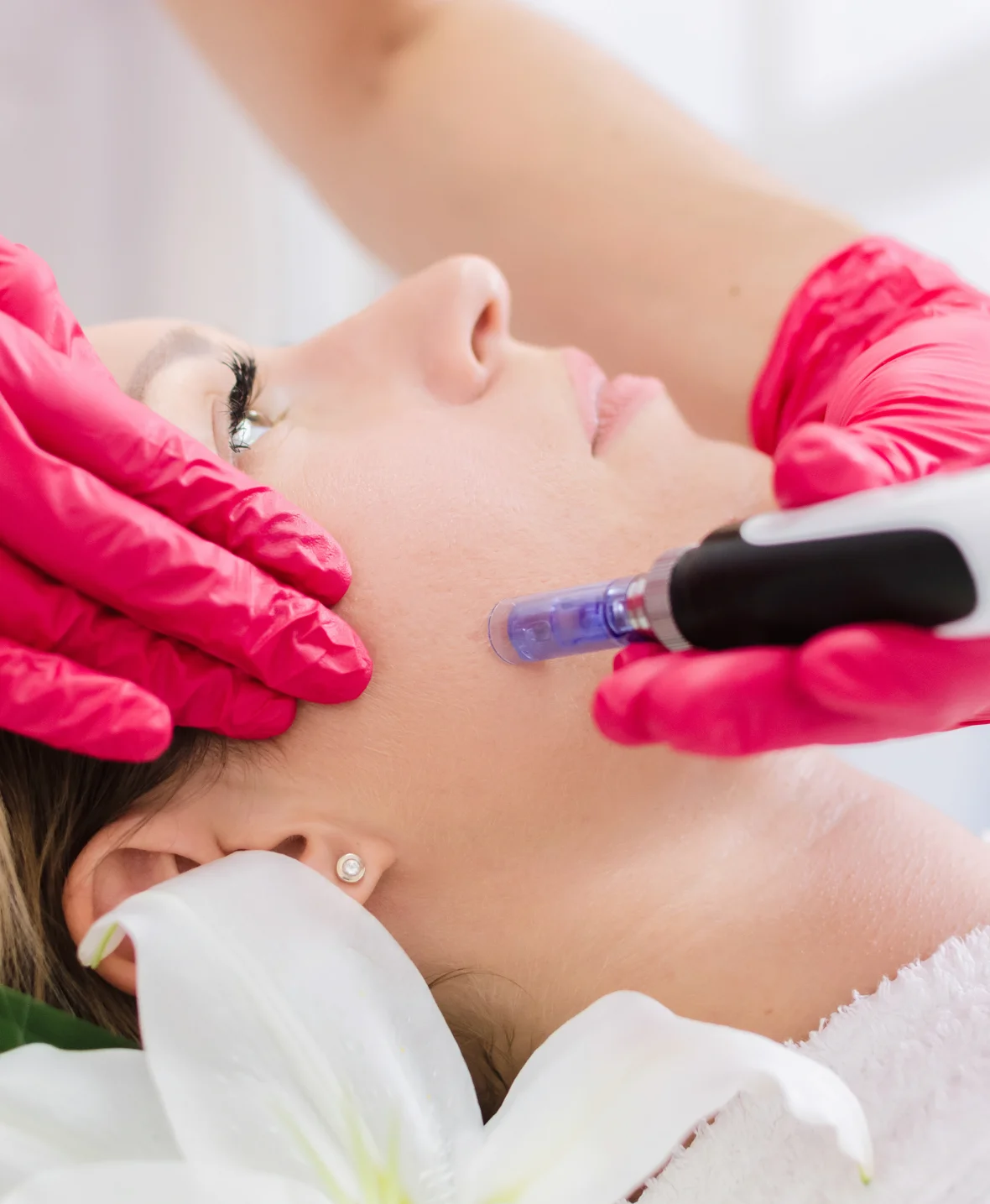 Cheek Augmentation Using Fat Graft img