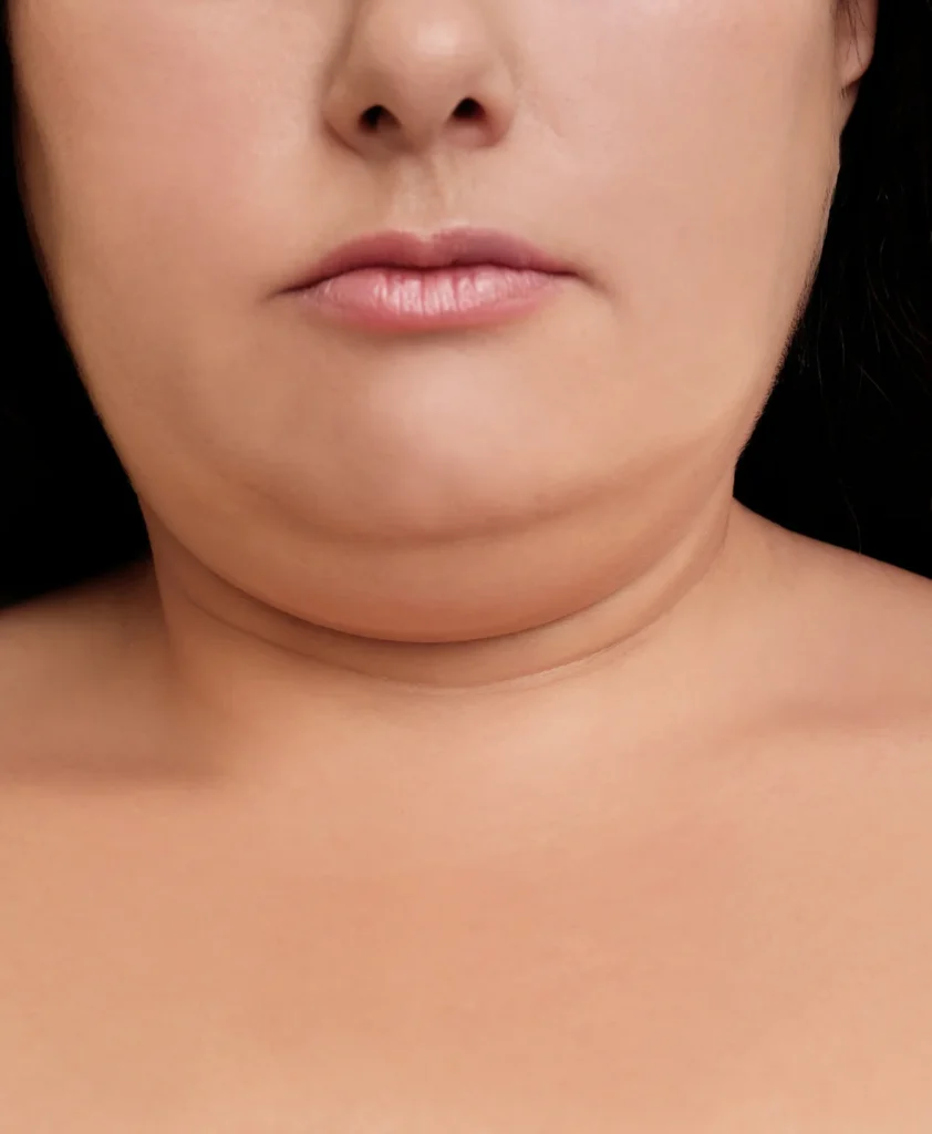 Cheek Augmentation Using Fat Graft img4