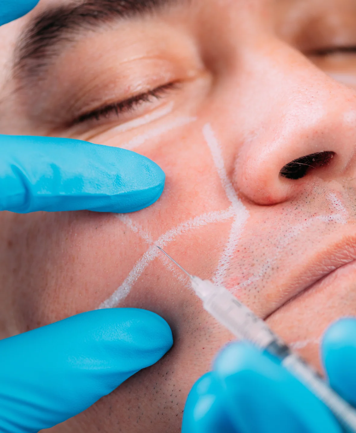 Cheek Implant Removal img3