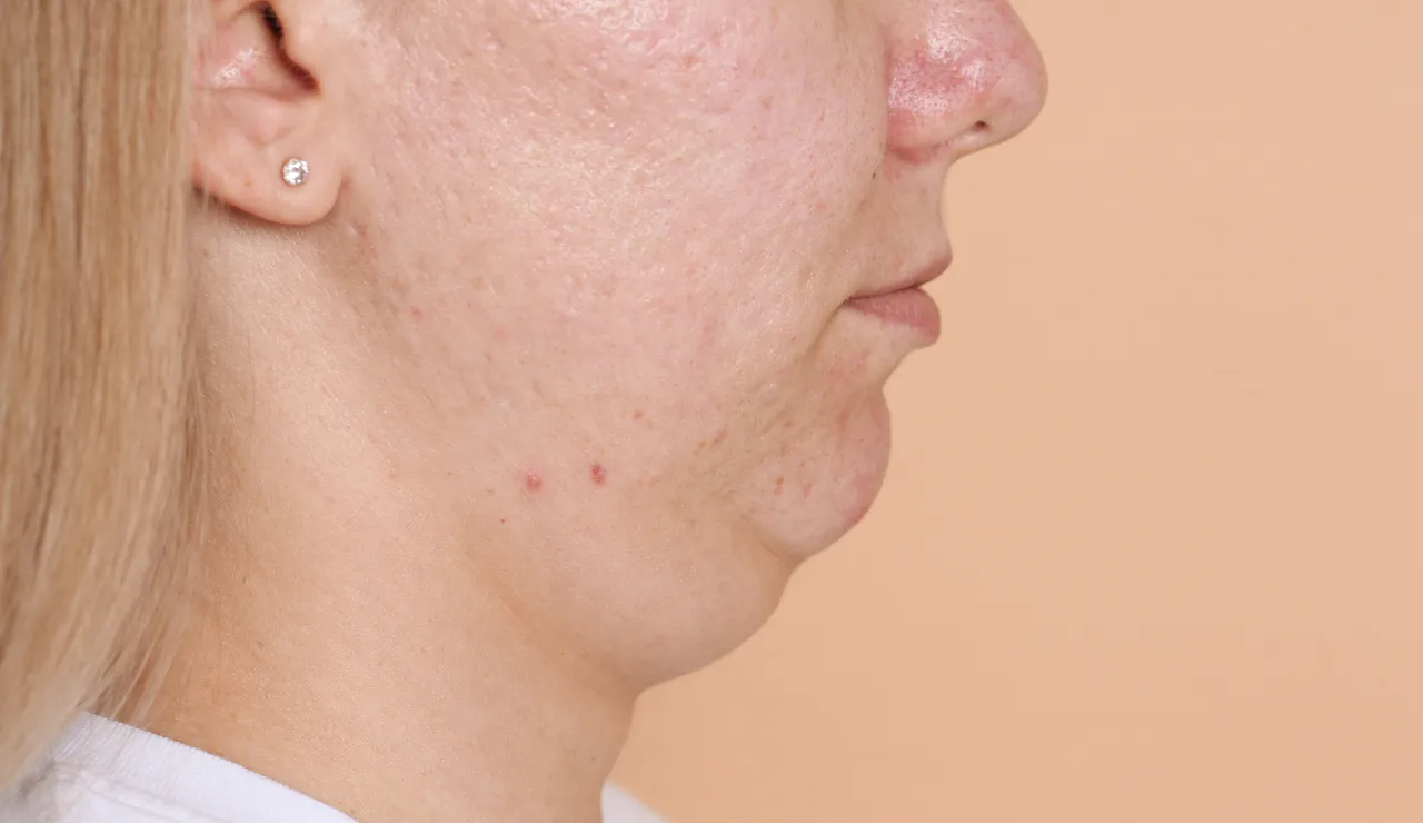 Chin implant testimonial img2