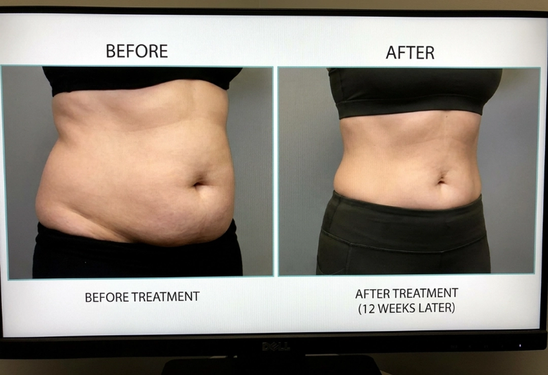 Before and after CoolSculpting showing reduced stubborn fat and improved body contour
