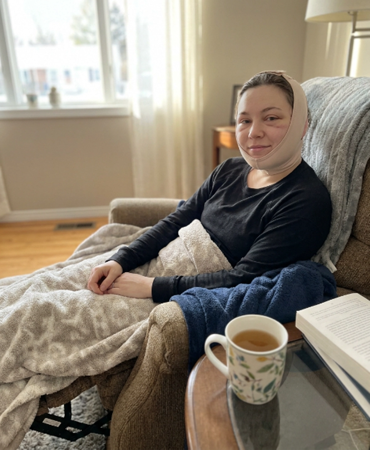 Patient recovering after FaceTite treatment while wearing a facial compression garment