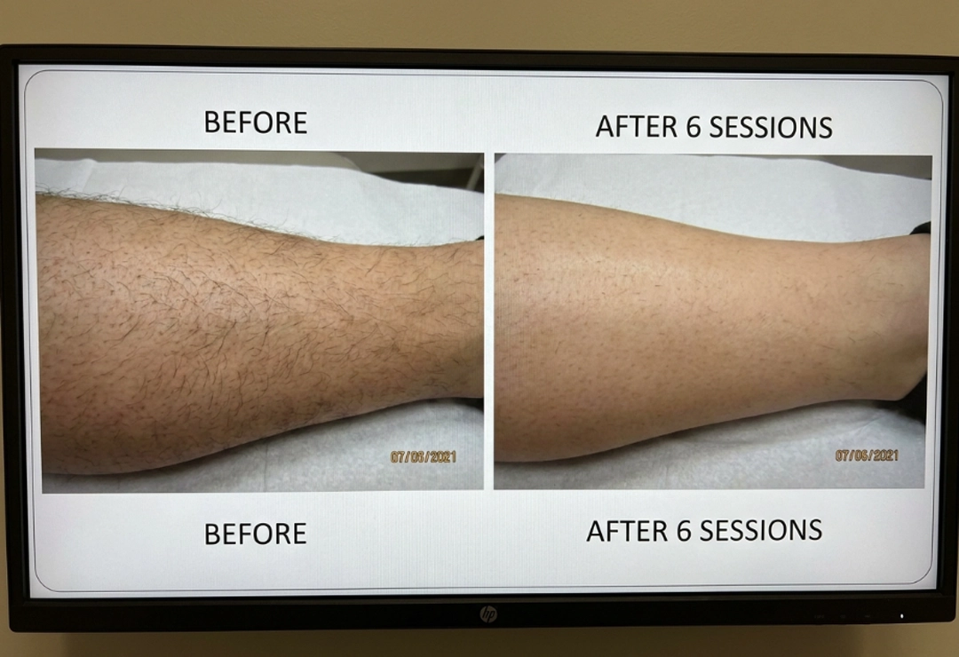 Before and after laser hair removal showing smoother skin and reduced hair growth
