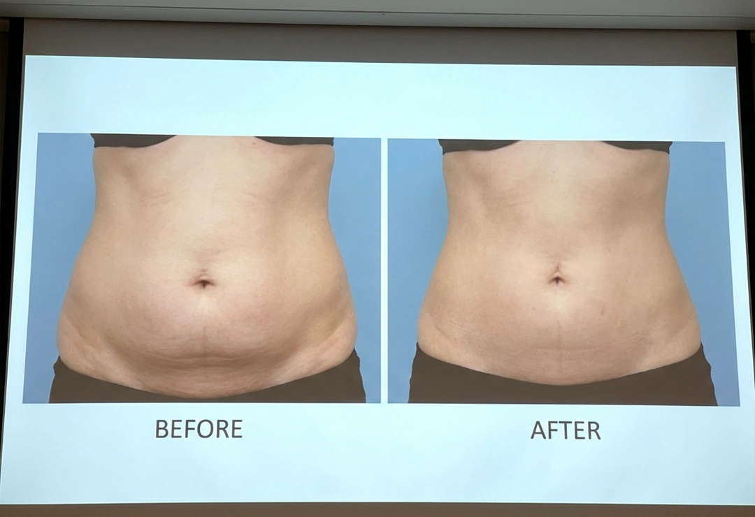 Before and after mini abdominoplasty showing flatter abdomen and improved body contour