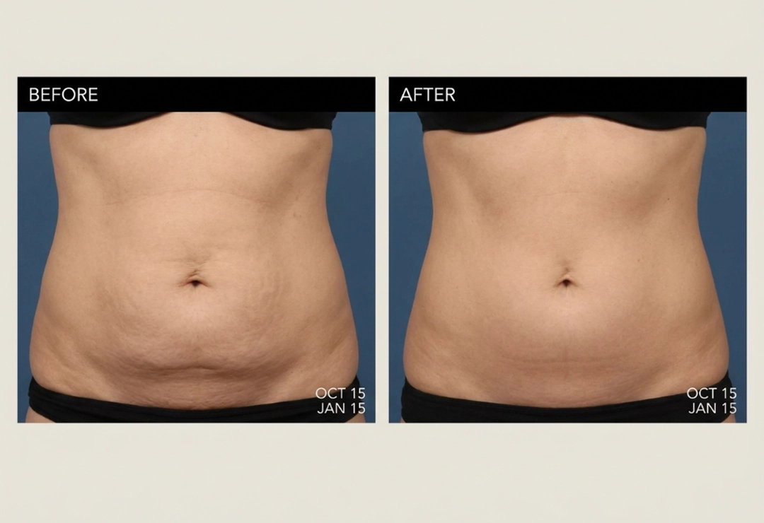 Before and after Morpheus8 treatment showing firmer skin and improved body contour
