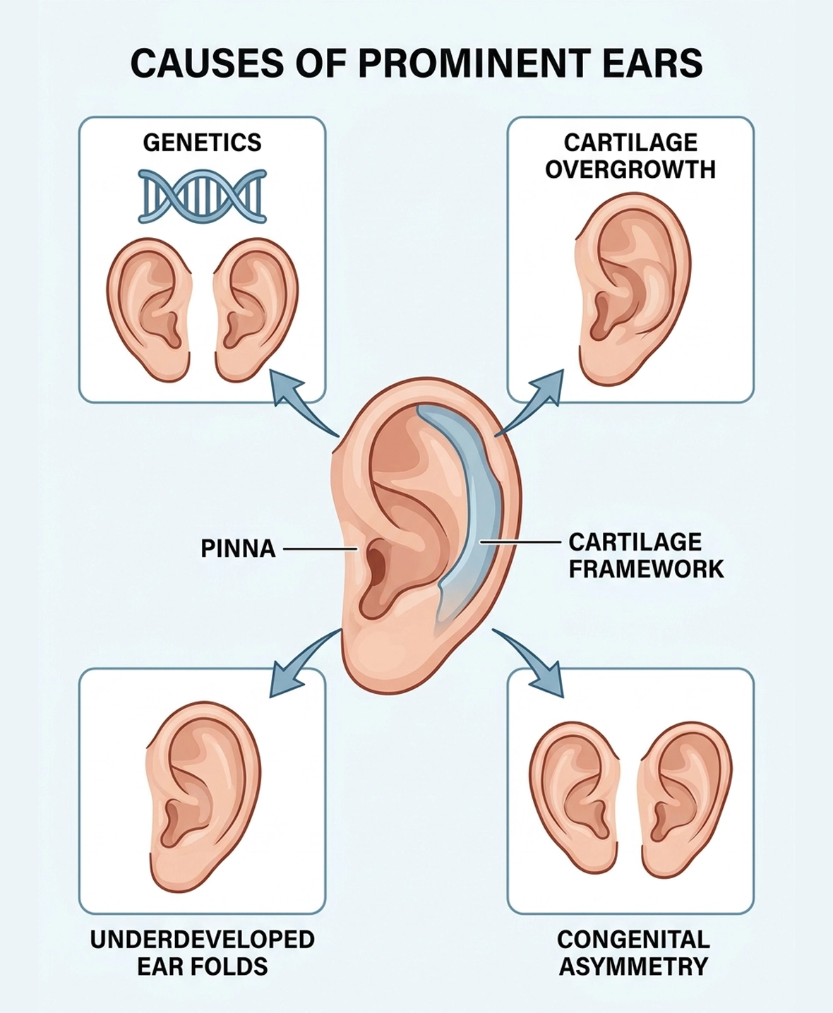 Common causes of prominent and asymmetrical ears treated with pinnaplasty surgery