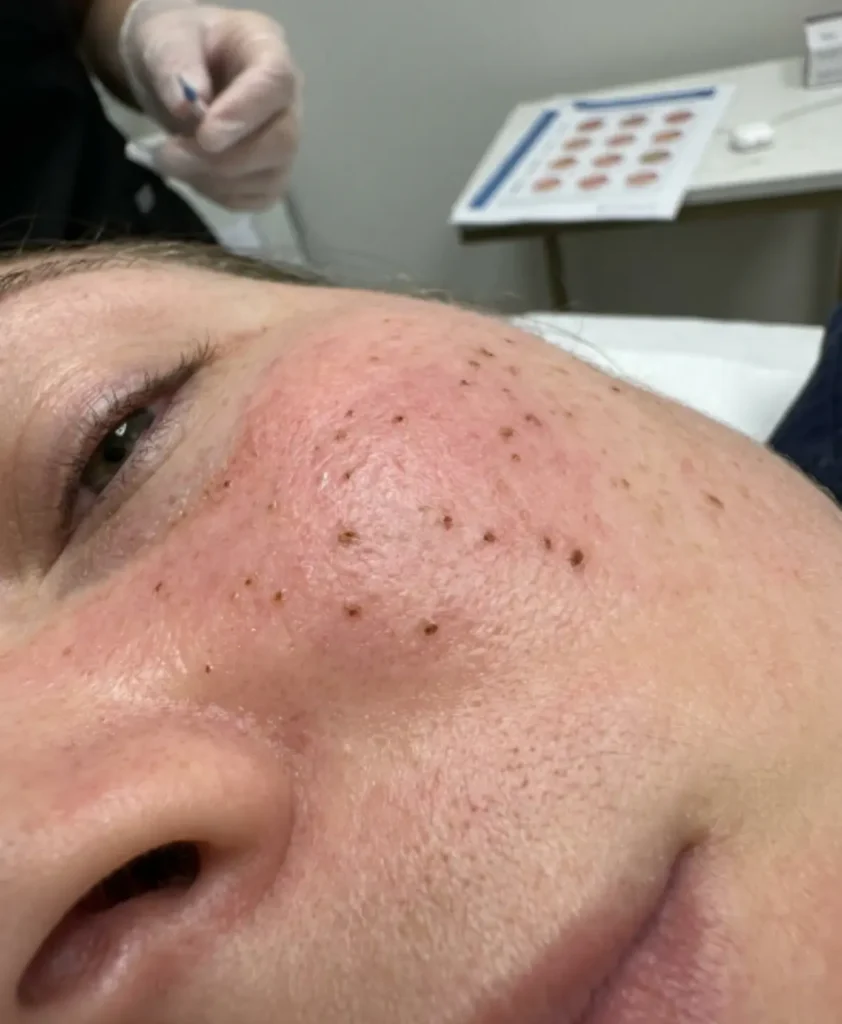 PLASMA IQ SKIN TIGHTENING IMAGE 6