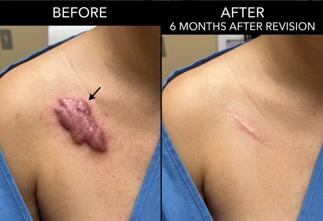 Before and after keloid scar revision showing flatter and improved scar appearance