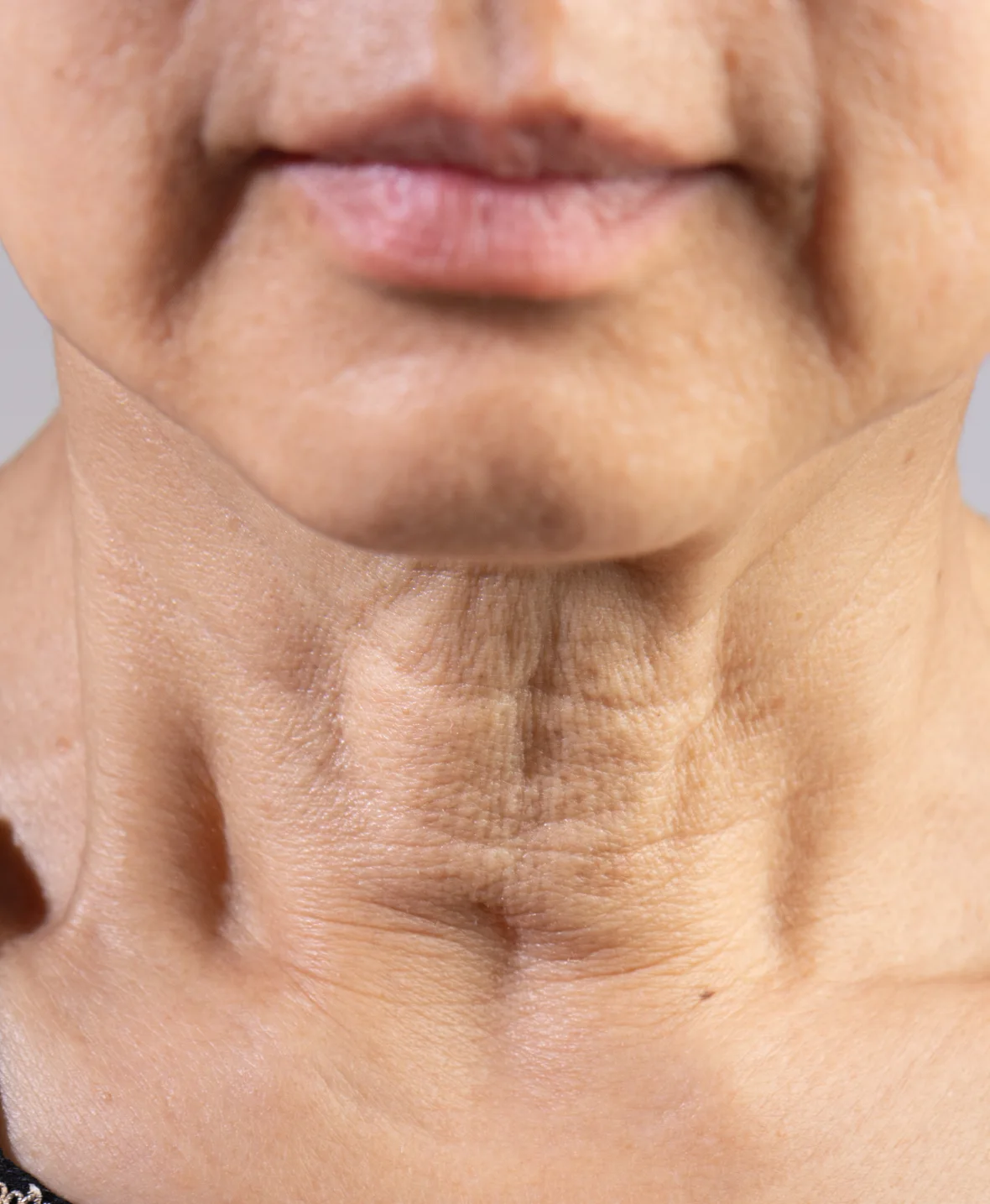 Surgical Neck Lift 1180x1435 2 1