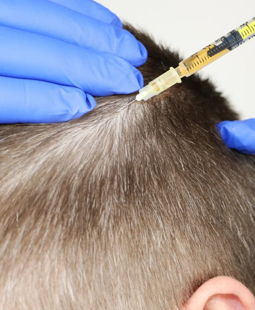 Close-up of a gloved hand administering a scalp injection