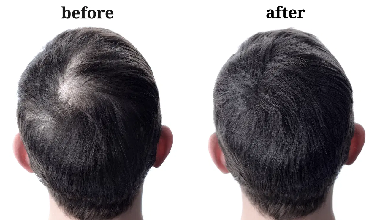 Hair Transplantation Testimonial 1