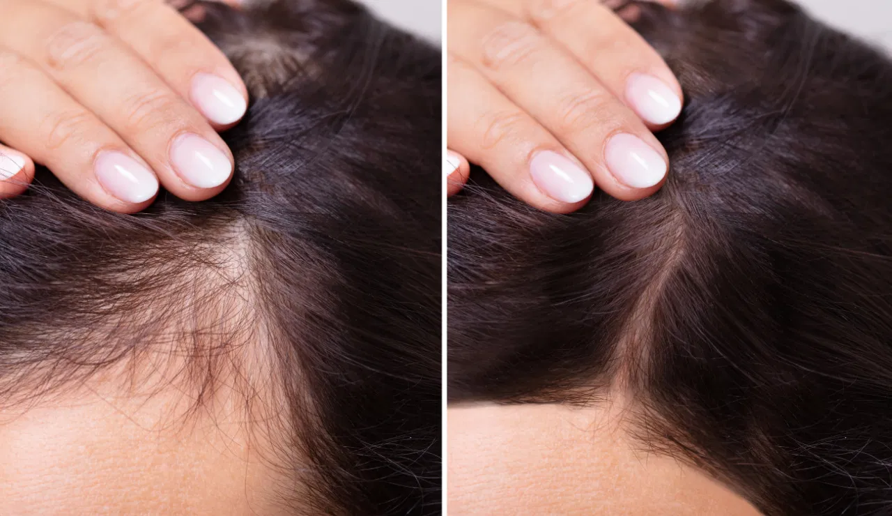 Hair Transplantation Testimonial 3