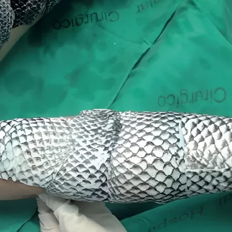 Acellular Fish Skin Grafts for Management of Split Thickness Donor Sites and Partial Thickness Burns A Case Series